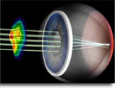 How LASIK works